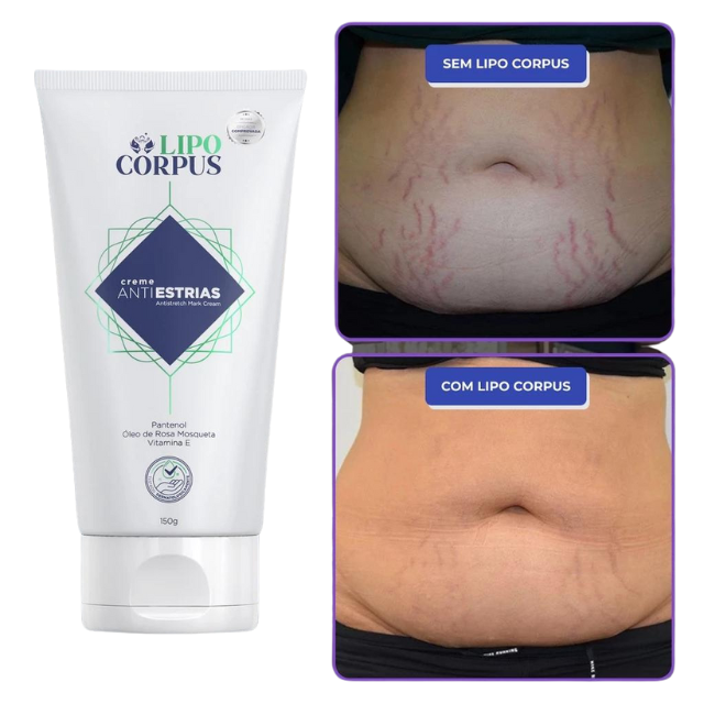 Lipo Corpus Creme para Remover Estrias