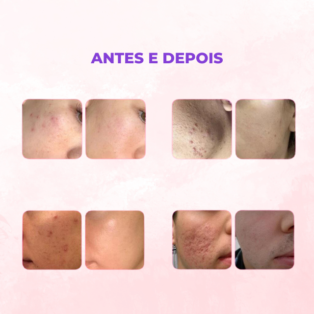 Máscara Facial 3 em 1 + Ácido Hialurônico - 90g