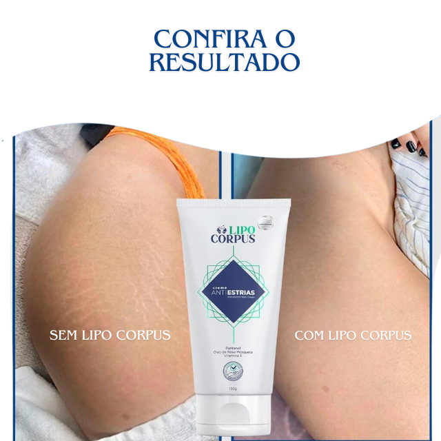 Lipo Corpus Creme para Remover Estrias